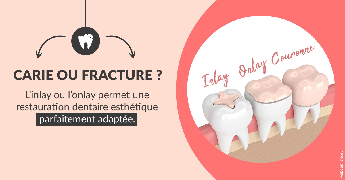https://dr-david-mailhes.chirurgiens-dentistes.fr/T2 2023 - Carie ou fracture 2