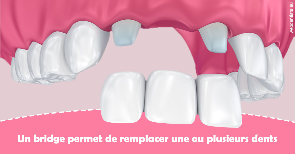 https://dr-david-mailhes.chirurgiens-dentistes.fr/Bridge remplacer dents 2