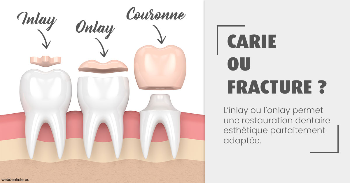 https://dr-david-mailhes.chirurgiens-dentistes.fr/T2 2023 - Carie ou fracture 1