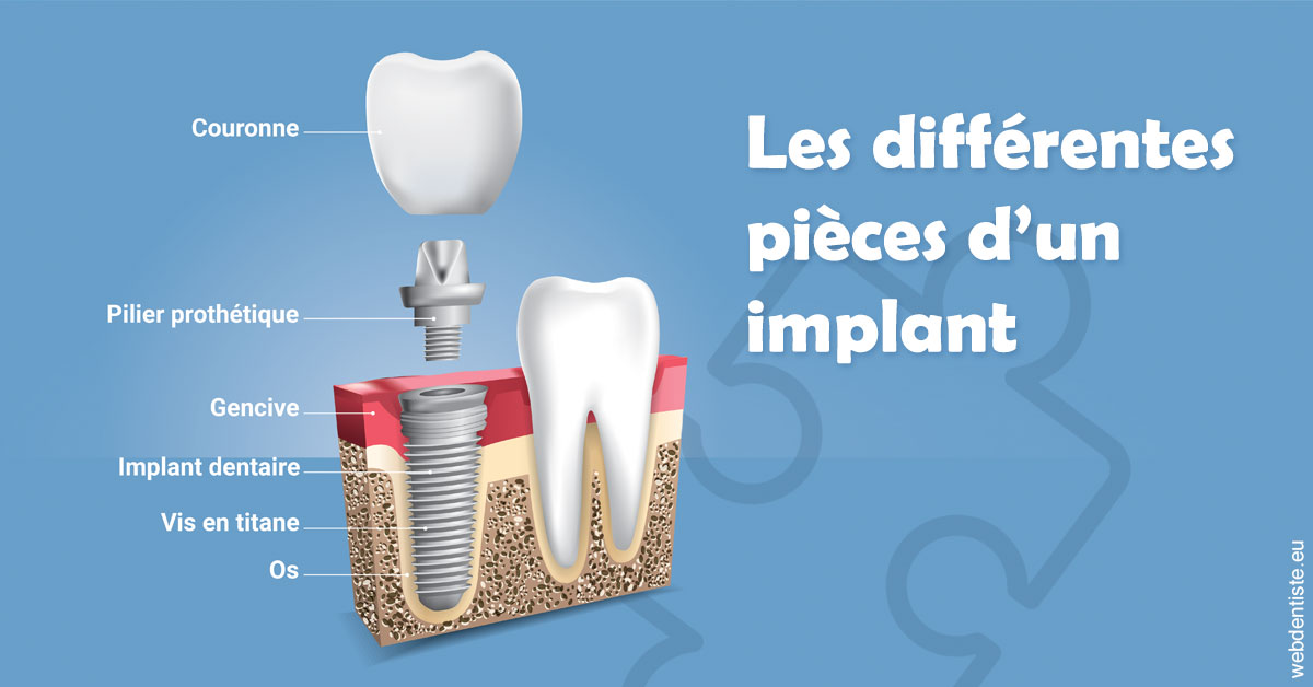 https://dr-david-mailhes.chirurgiens-dentistes.fr/Les différentes pièces d’un implant 1